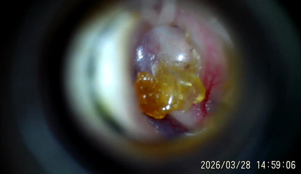 Otoscope view of a wax plug being removed from the ear canal