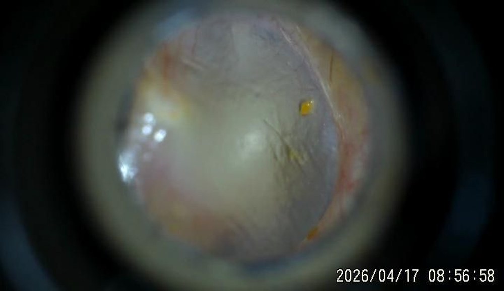 Otoscope view of a clear, healthy ear canal after microsuction treatment, with the eardrum visible