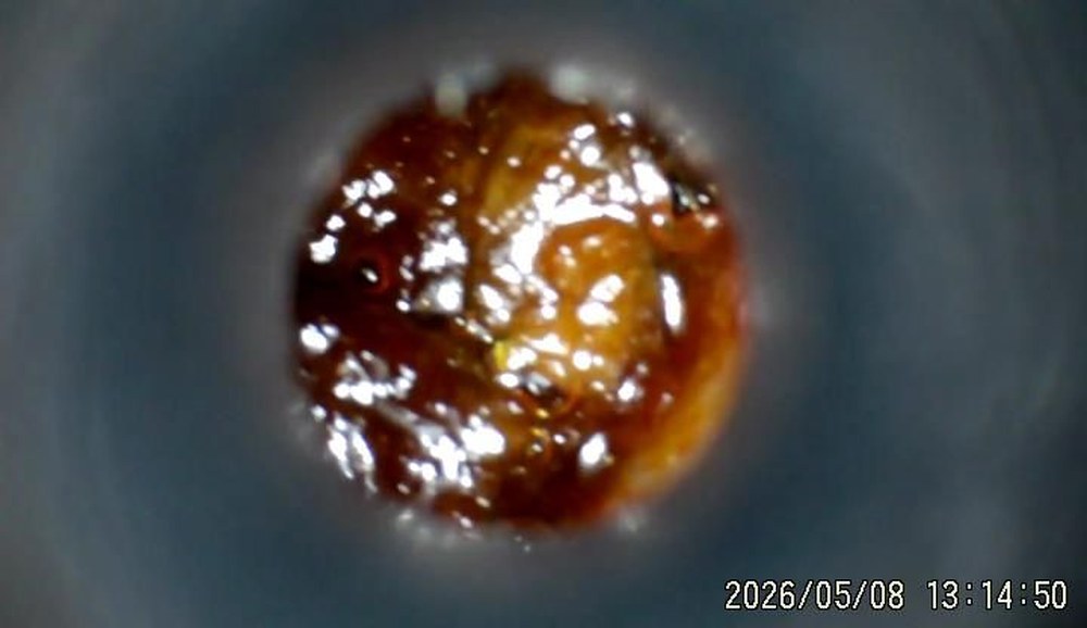 Otoscope view of an ear canal heavily blocked with amber-coloured wax before treatment